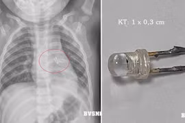 Gắp dị vật trong đường thở bé 10 tháng tuổi