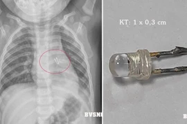 Gắp dị vật trong đường thở bé 10 tháng tuổi