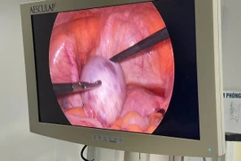 Đau bụng âm, mệt mỏi, đi khám phát hiện u nang buồng trứng xoắn