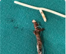 Vòng tránh thai "đi lạc" trong bụng cụ bà 40 năm