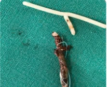 Vòng tránh thai "đi lạc" trong bụng cụ bà 40 năm