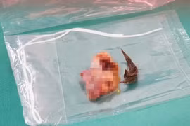 Cắt bỏ khối u quái buồng trứng chứa đầy lông cho nữ bệnh nhân 36 tuổi