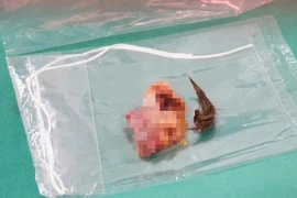 Cắt bỏ khối u quái buồng trứng chứa đầy lông cho nữ bệnh nhân 36 tuổi