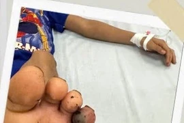 Không nên tự ý chữa rắn cắn bằng thuốc nam chưa được kiểm chứng