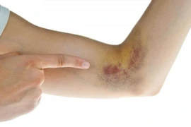 Dấu hiệu cơ thể thiếu hụt vitamin K, cần bổ sung ngay