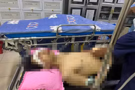 Nam sinh bị dập nát bàn tay, tổn thương 2 mắt sau tiếng nổ lớn