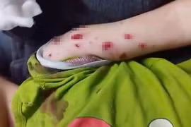 Bé trai 4 tuổi bị đa chấn thương do nhặt “vật lạ” phát nổ