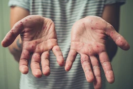 Virus đậu mùa khỉ có thể tồn tại trên các bề mặt