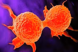 Nếu ở cổ có 3 “tín hiệu” thì có thể là báo hiệu cho tế bào ung thư “hoạt động”