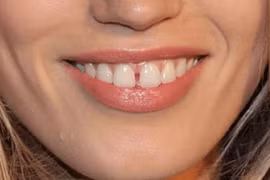 Nhìn tướng răng đoán ngay số phận giàu có hay nghèo hèn