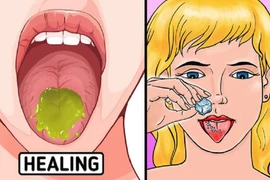 Ăn lẩu, nướng nhiều bị bỏng rát lưỡi và 10 cách chữa lành cấp tốc