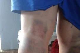 Nam sinh lớp 6 ở Quảng Nam bị đánh bầm tím 2 chân