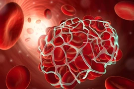 Cẩn trọng đột quỵ mùa nóng và cách phòng ngừa hiệu quả