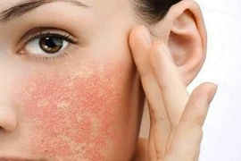 Các cách trị dị ứng da mặt đơn giản tại nhà