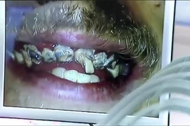 Chàng trai 20 năm không đánh răng và cái kết 