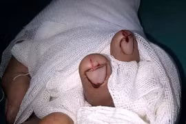 Hy hữu: Đứt ba ngón tay vì nổ lốp xe