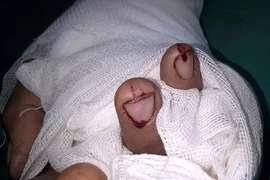 Hy hữu: Đứt ba ngón tay vì nổ lốp xe