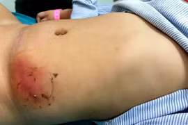 Con bỗng hoại tử vùng bụng do mẹ dán loại cao phổ biến trị mụn