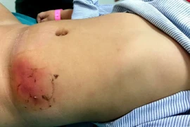 Con bỗng hoại tử vùng bụng do mẹ dán loại cao phổ biến trị mụn