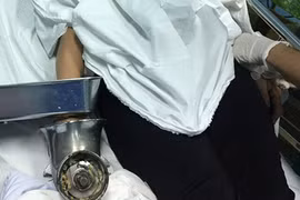 Người phụ nữ vô tình bị cuốn cả bàn tay vào máy xay thịt