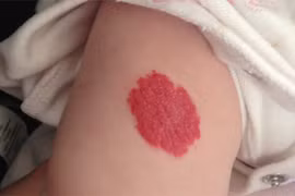 Vết bớt nằm ở đâu giúp mang lại tiền tài, may mắn?