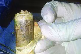 Bác sỹ "khóc thét" thấy bọc tiền trong bụng bệnh nhân