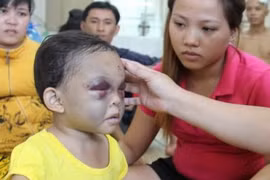  Trẻ bị chấn thương đầu - Trường hợp nào cần cấp cứu? 