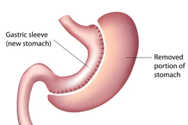 "Soi" phương pháp giảm cân được cho hiệu quả nhất hiện nay