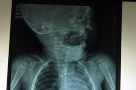 Hãi hùng phát hiện tụ điện trong phế quản bé 8 tháng tuổi