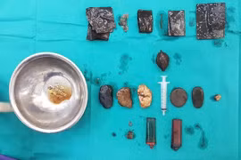 Cứu sống "dị nhân" nuốt dao lam, bác sỹ "mò" được đống đồ trong dạ dày