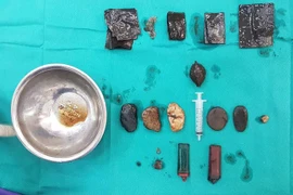 Cứu sống "dị nhân" nuốt dao lam, bác sỹ "mò" được đống đồ trong dạ dày