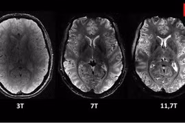 Siêu máy quét MRI cho hình ảnh rõ nét nhất về bộ não người
