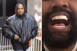 Chi 850.000 USD để độ răng, Kanye West đối mặt hiểm họa 