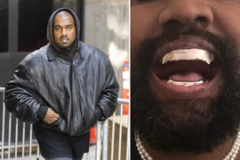 Chi 850.000 USD để độ răng, Kanye West đối mặt hiểm họa 