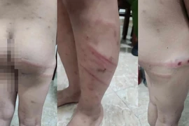 Khẩn trương điều tra, xử lý vụ bé 11 tuổi bị bạo hành dã man