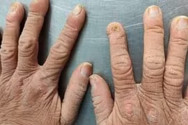 Căn bệnh hiếm gặp khiến cô gái có vẻ ngoài già nua