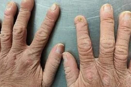 Căn bệnh hiếm gặp khiến cô gái có vẻ ngoài già nua