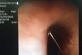 Hoảng hồn bé 4 tuổi nuốt kim băng, bị đầu nhọn cắm vào thực quản