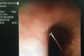 Hoảng hồn bé 4 tuổi nuốt kim băng, bị đầu nhọn cắm vào thực quản