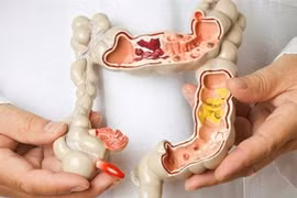 Hàng triệu người Việt vệ sinh sai cách sau đại tiện, tăng nguy cơ bệnh tật 