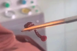 Gắp con vắt dài 3 cm sống trong mũi người đàn ông ở Quảng Bình