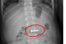 Cháu bé ở Quảng Trị nuốt phải cây đinh vít xoắn nhọn