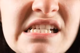 Người phụ nữ trật khớp thái dương hàm sau... ngáp to