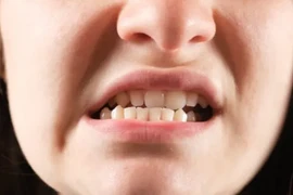 Người phụ nữ trật khớp thái dương hàm sau... ngáp to