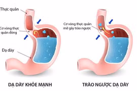 Cách tránh trào ngược dạ dày, thực quản trong và sau Tết
