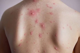 Bến Tre: Phát hiện hơn 80 ca mắc thủy đậu tại một công ty