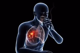 Nhiều bệnh về ung thư có nguyên nhân từ hút thuốc lá