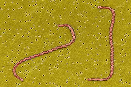 Sốt, đau đầu tưởng “ốm xoàng”, đi khám phát hiện vi khuẩn gây viêm màng não 