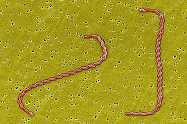 Sốt, đau đầu tưởng “ốm xoàng”, đi khám phát hiện vi khuẩn gây viêm màng não 