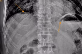 Thường xuyên uống rượu, người đàn ông bị thủng tạng rỗng